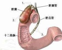十二指肠瘘