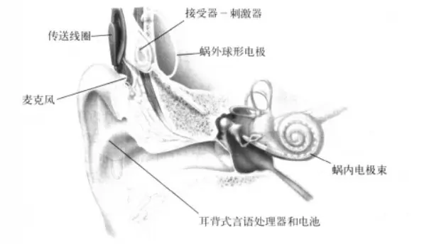 人工耳蜗