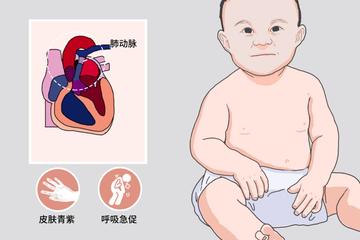 肺动脉闭锁-肺动脉闭锁