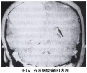 大脑凸面脑膜瘤-大脑凸面脑膜瘤