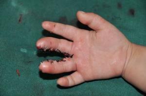 并指畸形-并指畸形