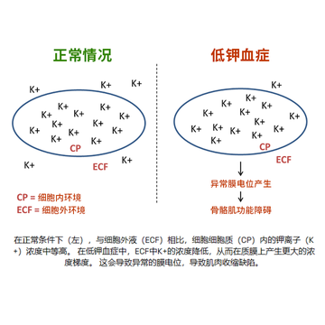 低钾血症