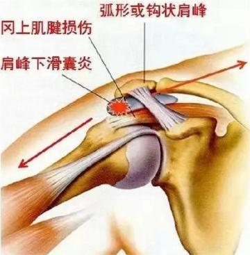 肩峰下滑囊炎