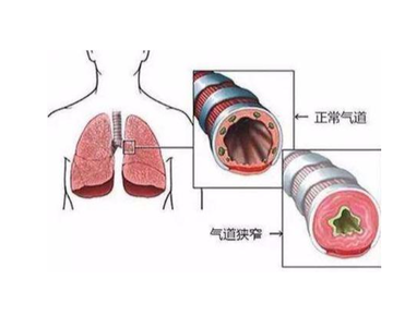 呼吸道狭窄