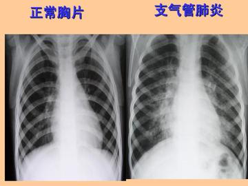 小儿支气管肺炎