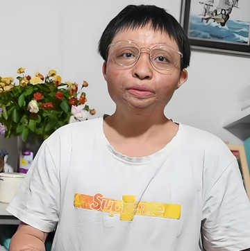 唐敏-云南因救弟致残的女孩